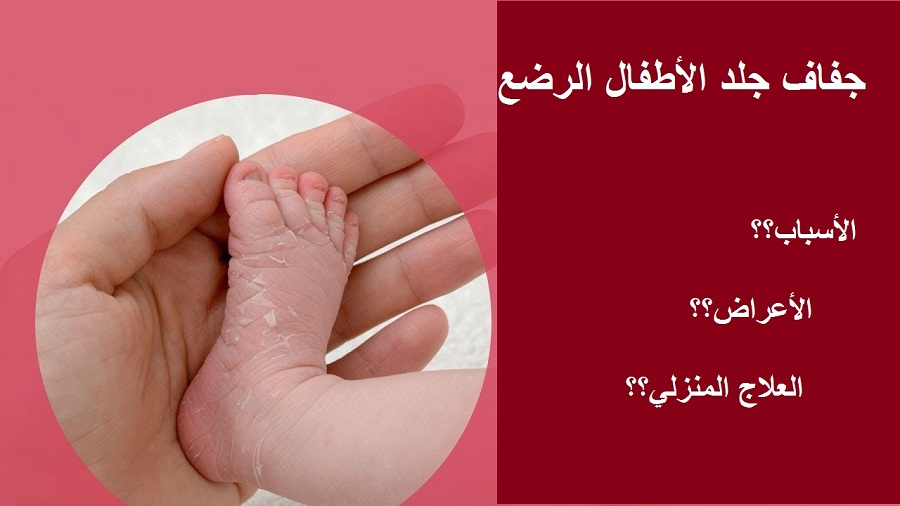أسباب جفاف جلد الأطفال الرضع