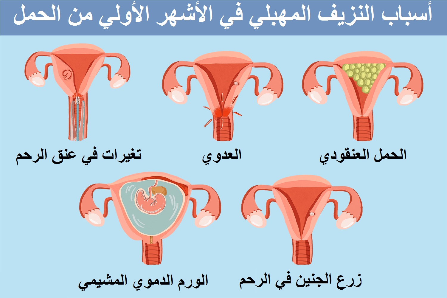 اسباب النزيف المهبلي للحامل فى الاشهر الاولي من الحمل