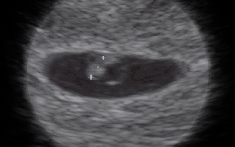 جنين في الاسبوع السادس من الحمل بالموجات فوق الصوتية