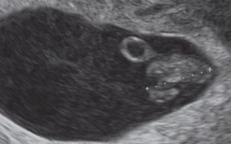 الموجات الصوتية لجنين في الاسبوع السابع من الحمل