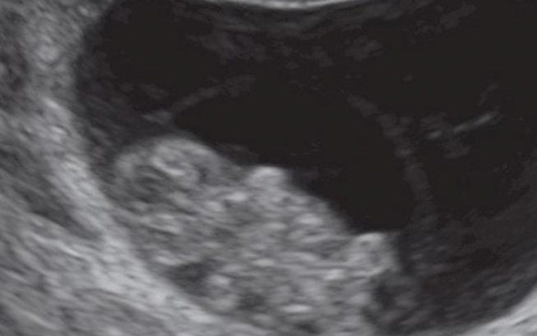 الموجات فوق الصوتية للجنين في الاسبوع الثامن من الحمل