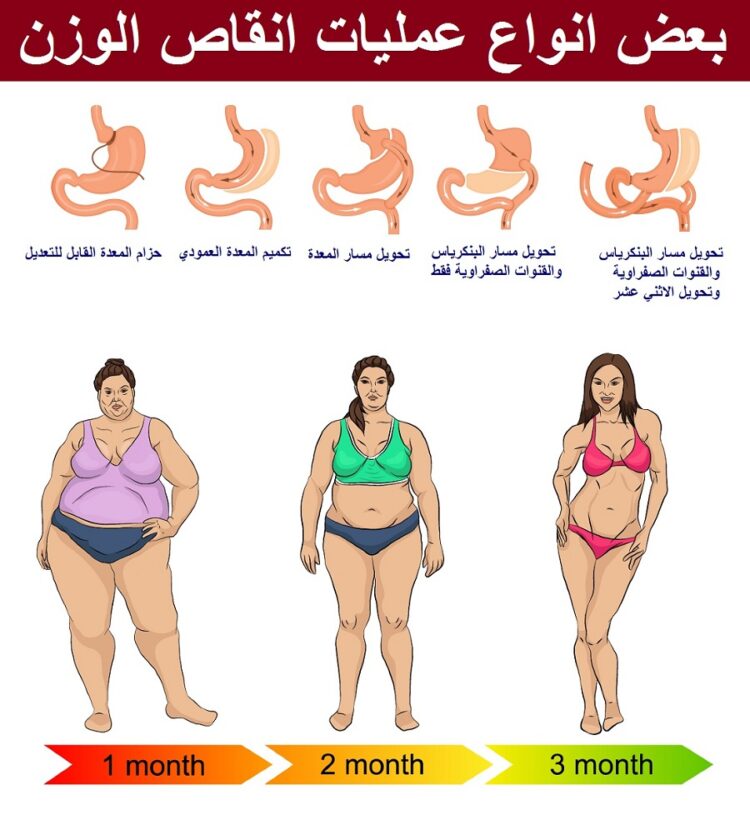 أنواع عمليات إنقاص الوزن