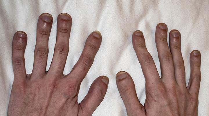 تعجر الأصابع هو أحد أعراض التليف الرئوي