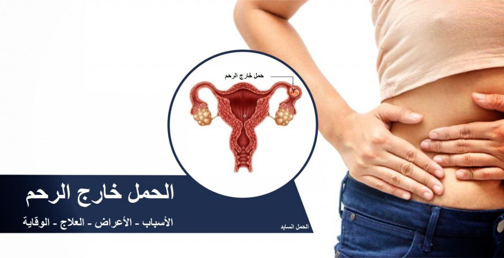 الحمل خارج الرحم: الاعراض والمضاعفات وطرق منع تكراره